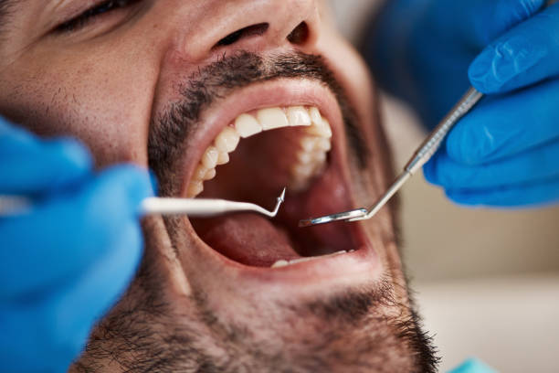 Best Knocked-Out Tooth (Avulsed Tooth) Treatment in Grant Park, IL
