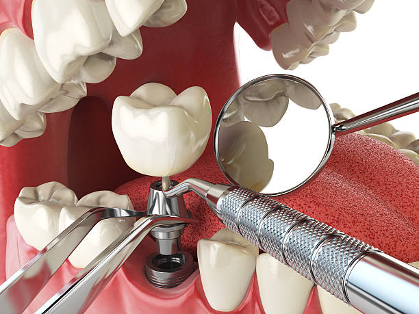 Best Lost Filling or Crown Replacement in Grant Park, IL